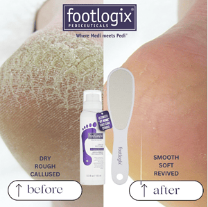 Kujdesi për këmbët me produktet Footlogix për lëkurë të thatë dhe të lëmuar.